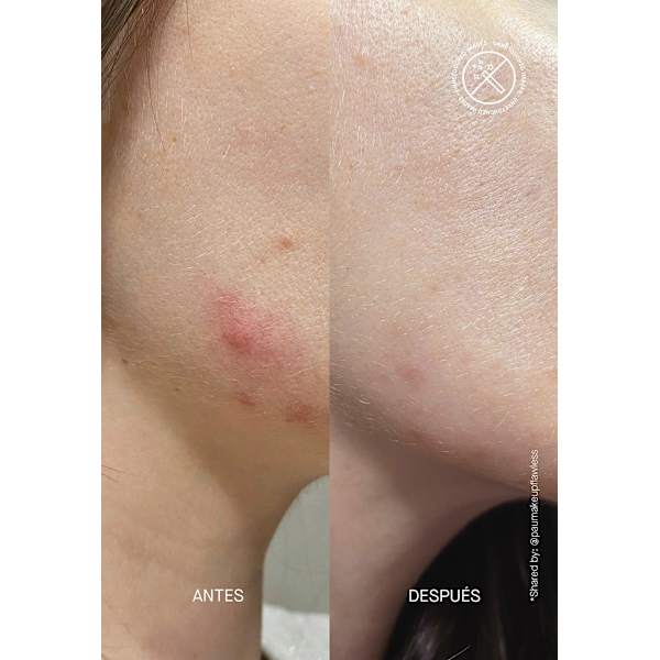 Anti Pickel Serum Postzit Acnemy