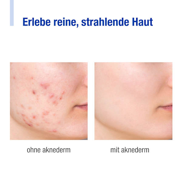 Gesichtscreme H Aknederm