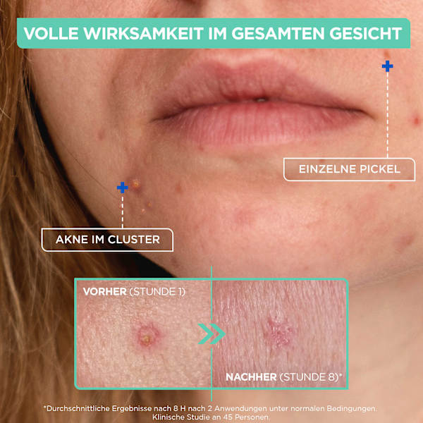 Anti Pickel Paste Mixa