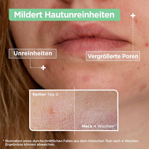 Serum Anti-Unreinheiten, Niacinamide Mixa